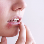 Nhận biết các dấu hiệu bệnh lậu ở miệng