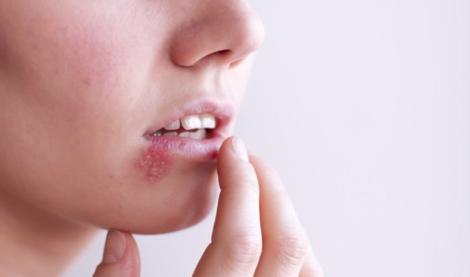 Dấu hiệu chính của bệnh lậu miệng là gì?
