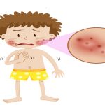 Bệnh viêm da mủ là gì? Có nguy hiểm không?