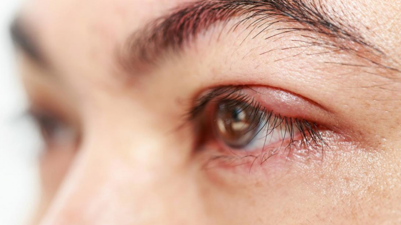 cách chữa ngứa mắt tại nhà