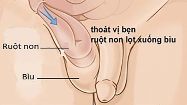 biến chứng thoát vị bẹn ở trẻ em