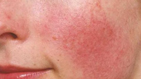 Lý giải tình trạng da mặt bị đỏ rát và ngứa