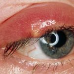 Viêm bờ mi mắt nguyên nhân và cách điều trị