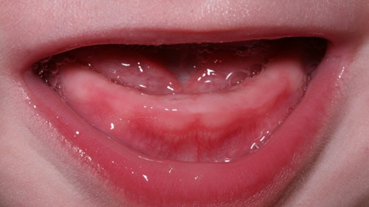Các triệu chứng mọc răng ở trẻ nhỏ là gì?
