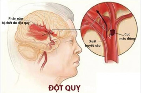 tác hại của thiếu máu lên não