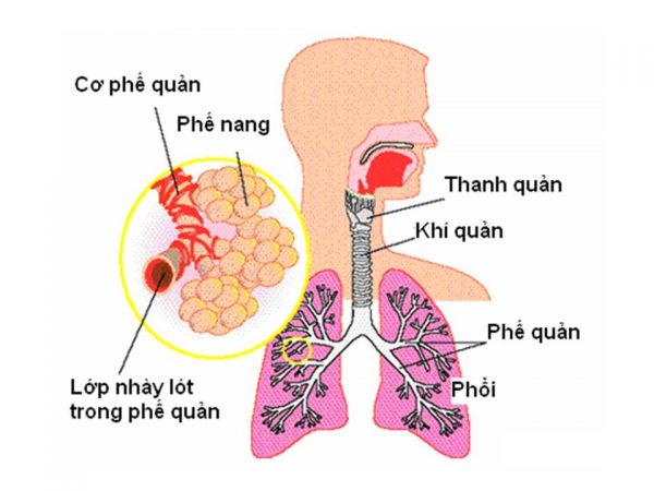 Nguyên nhân mắc bệnh có thể do bé gặp phải các bệnh lý đường hô hấp như hen phế quản, viêm phế quản, viêm phổi,...