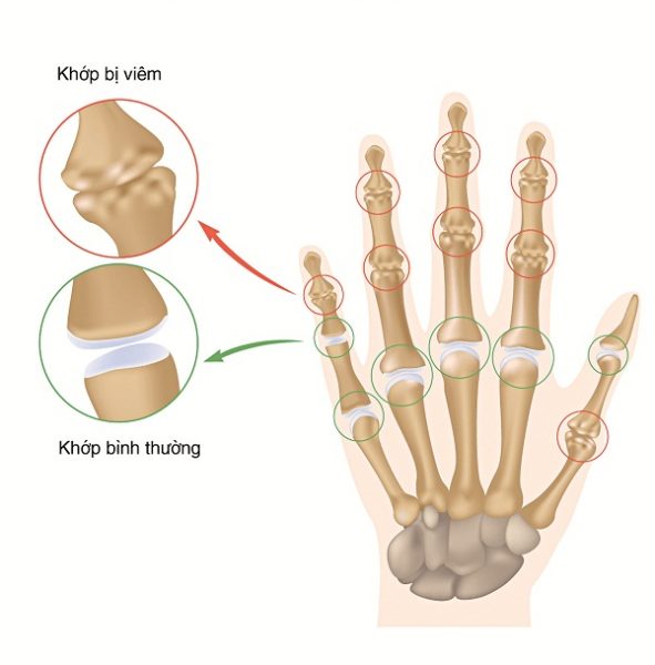 Khớp ngón tay bị đau làm thế nào cho mau khỏi?