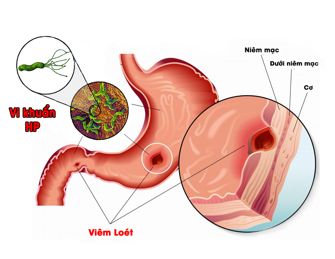 Xét nghiệm vi khuẩn HP bằng cách nào? | TCI Hospital