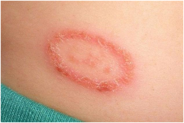 Dấu hiệu của bệnh hắc lào tăng mức độ tổn thương trên da