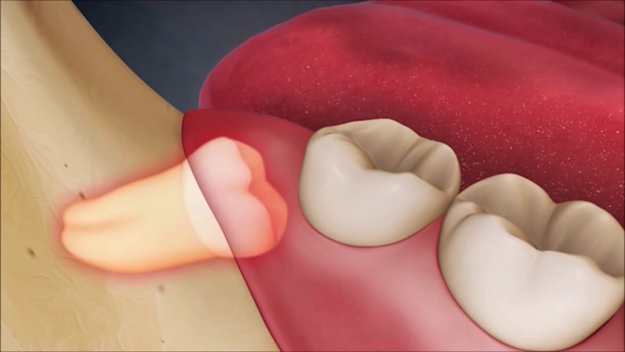 Tình trạng nào cần tới việc gặp răng hàm mặc định?
