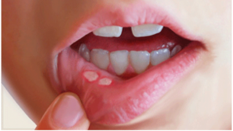 Loét niêm mạc miệng ở trẻ điều trị như thế nào?