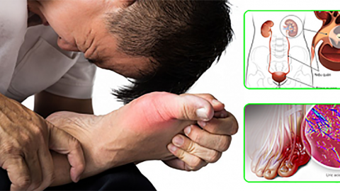 Bệnh nhân mắc bệnh gout có thể bị sỏi thận acid uric