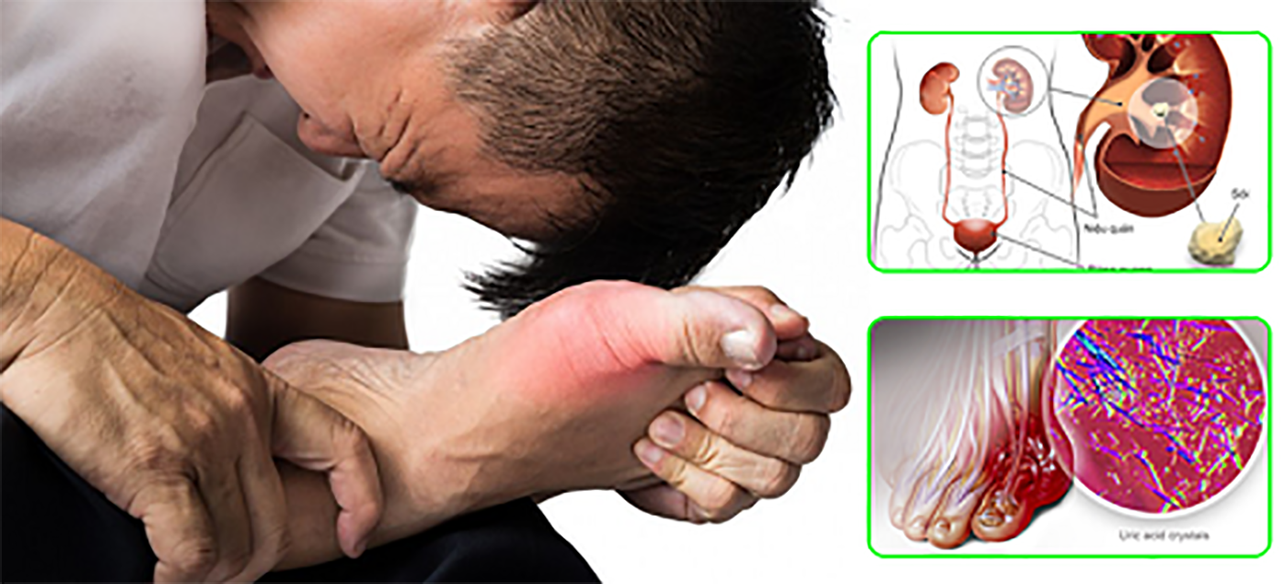 Bệnh nhân mắc bệnh gout có thể bị sỏi thận acid uric | TCI Hospital
