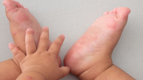 Bé bị nổi mẩn đỏ ở chân và tay là bệnh gì? 