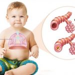 Chẩn đoán và điều trị viêm tiểu phế quản ở trẻ em