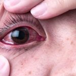 Bệnh đau mắt đỏ ở trẻ em nguyên nhân và cách điều trị