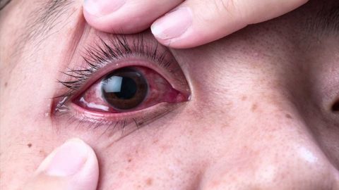 Bệnh đau mắt đỏ ở trẻ em nguyên nhân và cách điều trị