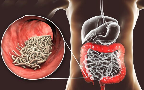 Bệnh kiết lỵ có nguy hiểm không và cách phòng bệnh | TCI Hospital