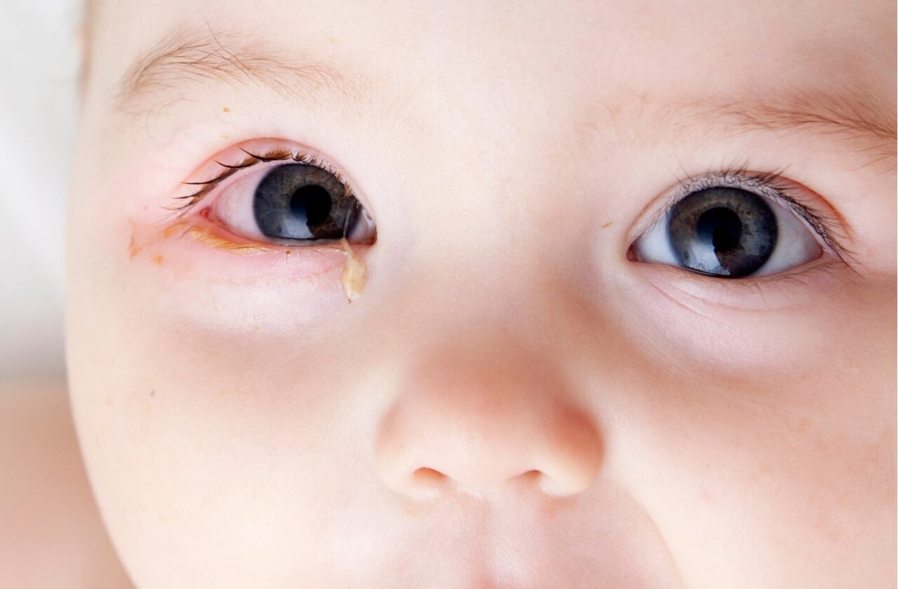 Các biểu hiện và triệu chứng khác kèm theo đau mắt đỏ ở trẻ em?
