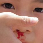 Trẻ bị chảy máu cam có nguy hiểm không?