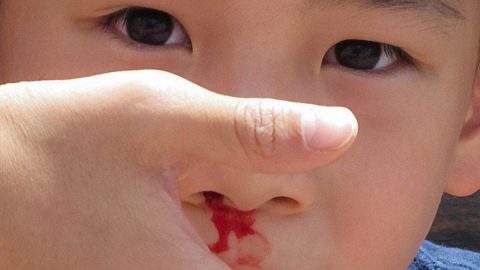 Trẻ bị chảy máu cam có nguy hiểm không?