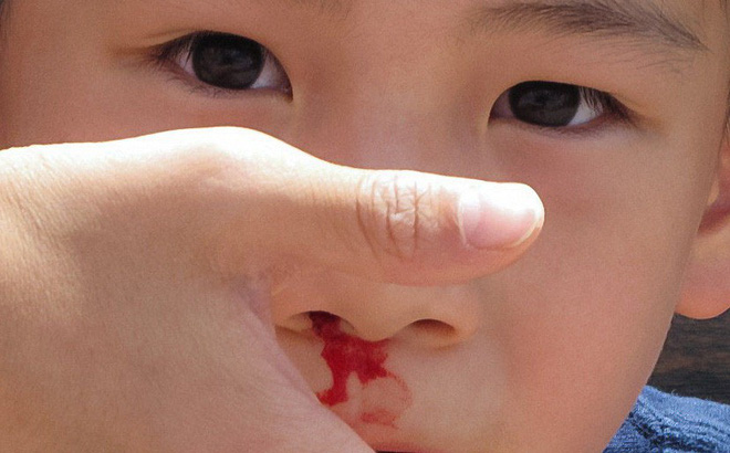 Chảy máu mũi có thể là triệu chứng của bệnh gì khác không?