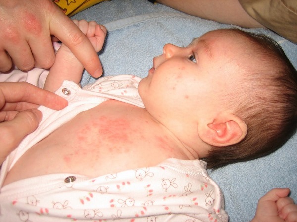 Dấu hiệu  trẻ sơ sinh bị zona không gây sẹo và viêm nhiễm?