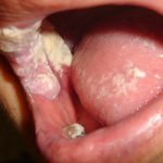 Nhận biết dấu hiệu bệnh lậu ở miệng