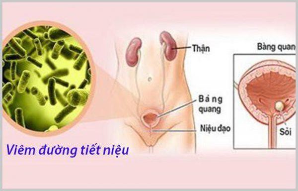 viêm đường tiết niệu có tự khỏi không