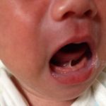 Những biểu hiện của bệnh lý dính thắng lưỡi ở trẻ nhỏ