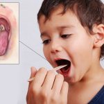 [Cảnh báo] Bệnh bạch hầu ở trẻ em dễ nhầm lẫn với bệnh viêm mũi họng