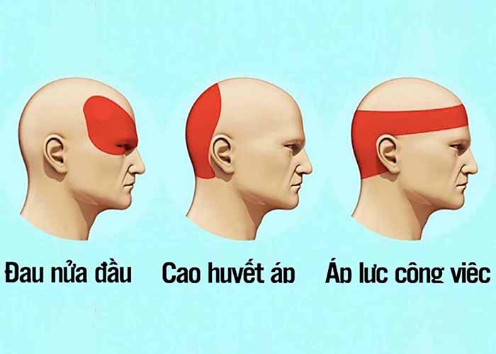 3 dạng bệnh đau đầu phổ biến là đau nửa đầu, đau đầu do cao huyết áp, đau đầu do áp lực, stress