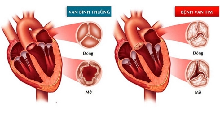 Các mức độ của bệnh hở van tim và những điều bạn cần biết