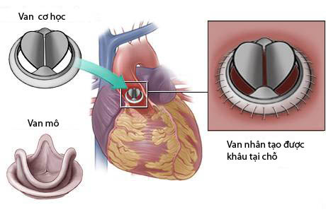 Các loại van tim thường được sử dụng trong phẫu thuật hở van tim