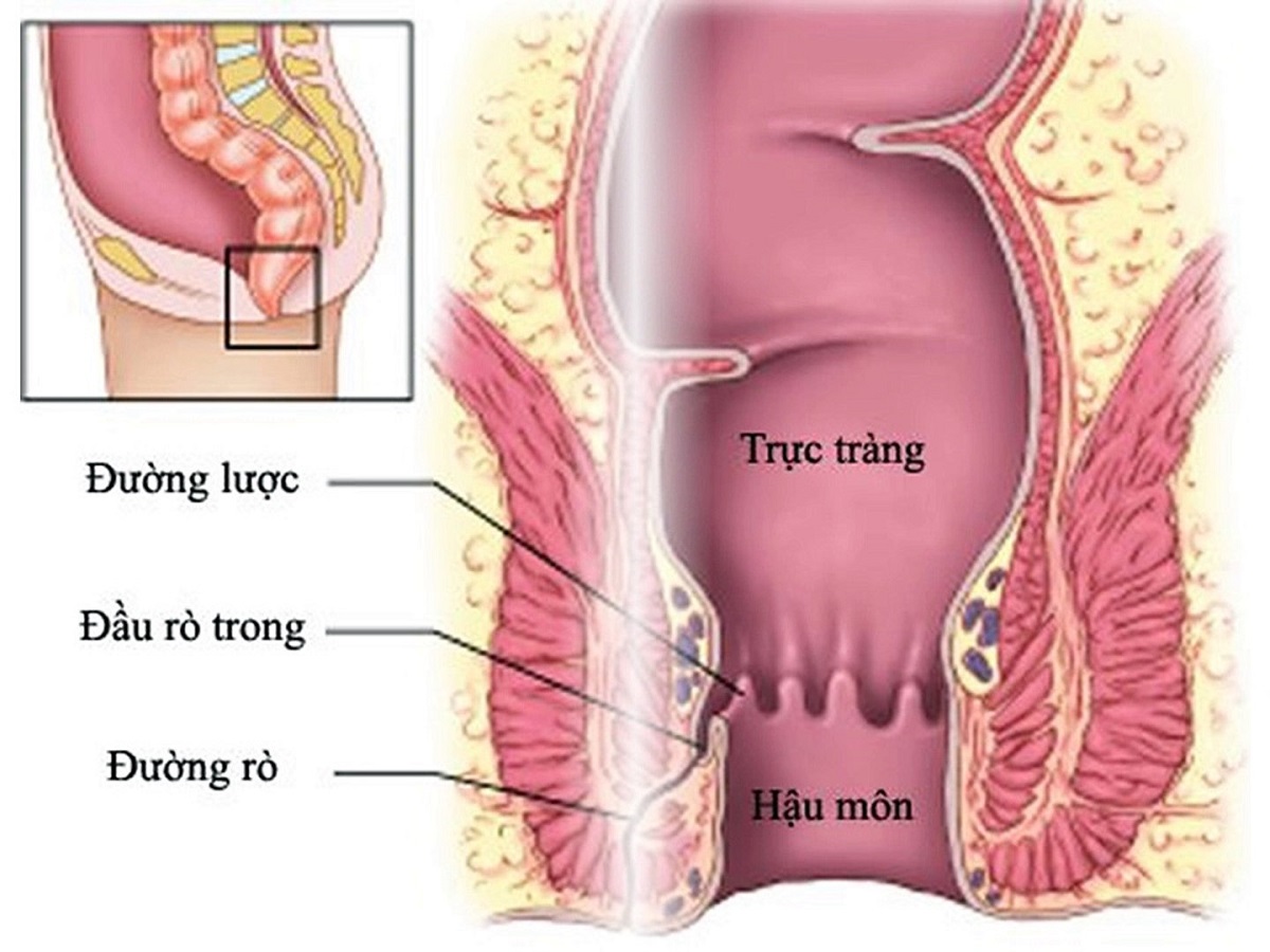 Rò hậu môn là căn bệnh gì và triệu chứng của nó là gì? 
