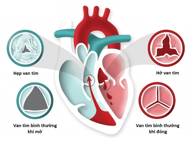 Bệnh hở van tim và những điều bạn cần phải biết