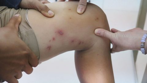 [CẢNH BÁO] Hơn 100 bệnh nhân đến khám mỗi ngày vì viêm da tiếp xúc do kiến ba khoang đốt