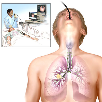 Có những loại người bệnh nào nên tránh nội soi phổi vì nguy cơ đau và rủi ro cao?
