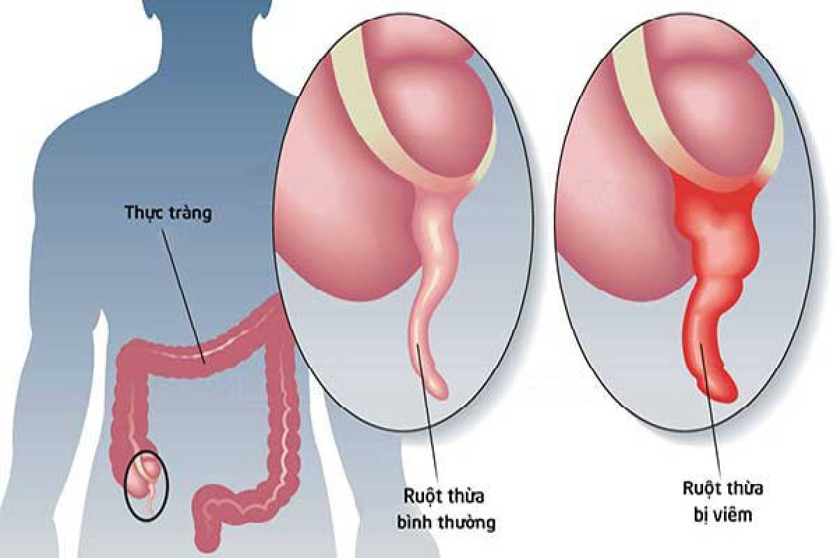 Viêm ruột thừa cấp: Nguyên nhân, triệu chứng và điều trị