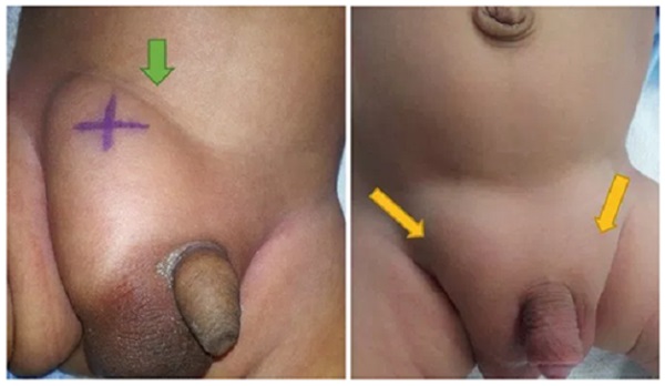 biểu hiện thoát vị bẹn trẻ sơ sinh