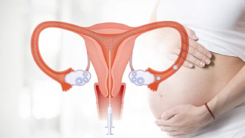 Những điều nên biết về phương pháp bơm tinh trùng vào tử cung