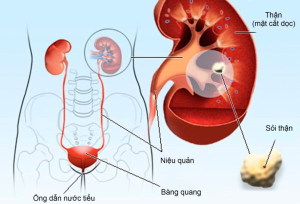 Sỏi có thể xuất hiện ở mọi cơ quan thuộc hệ tiết niệu