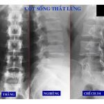 Chụp X-quang cột sống thắt lưng phát hiện bệnh gì?