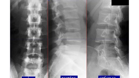 Chụp X-quang cột sống thắt lưng phát hiện bệnh gì?