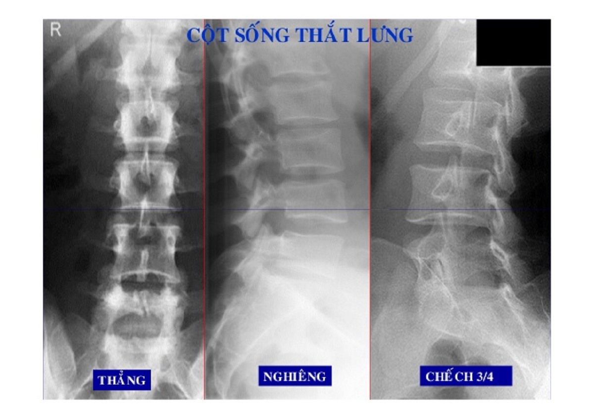 Chụp X-quang cột sống thắt lưng phát hiện bệnh gì? | TCI Hospital
