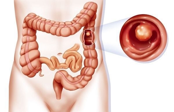 polyp đại tràng