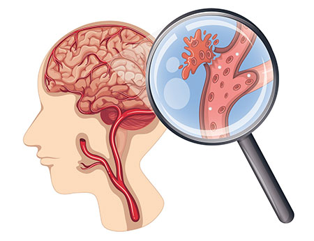 Đột quỵ não để lại những di chứng gì?