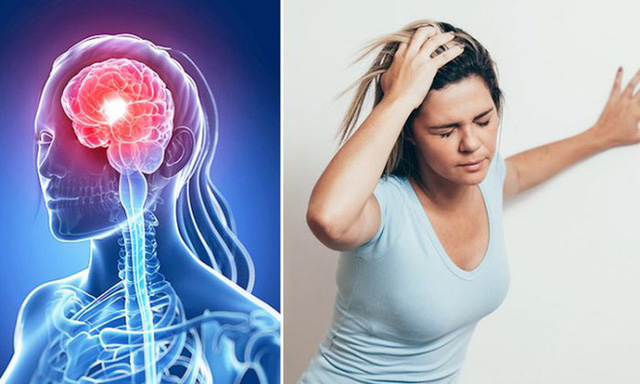 Đột quỵ não nguyên nhân chính gay tử vong và những biến chứng nguy hiểm khác