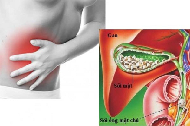 Mổ nội soi lấy sỏi ống mật chủ là bước tiến mới trong điều trị sỏi mật