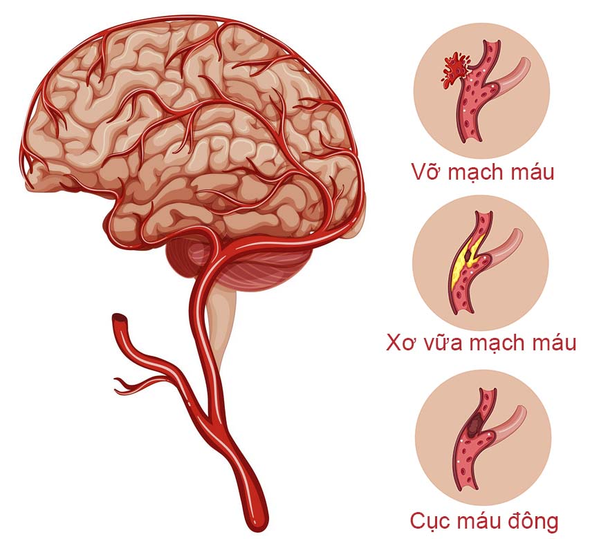 Nguyên nhân chính gây đột quỵ não là gì?